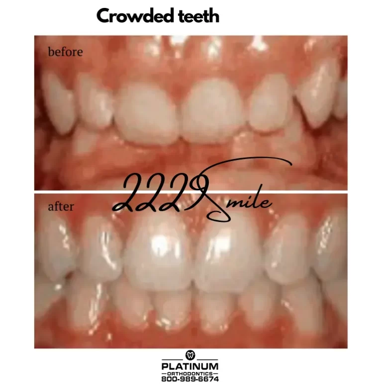 Before and after: Crowded Teeth