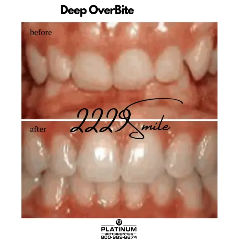 Before and after: Deep Overbite