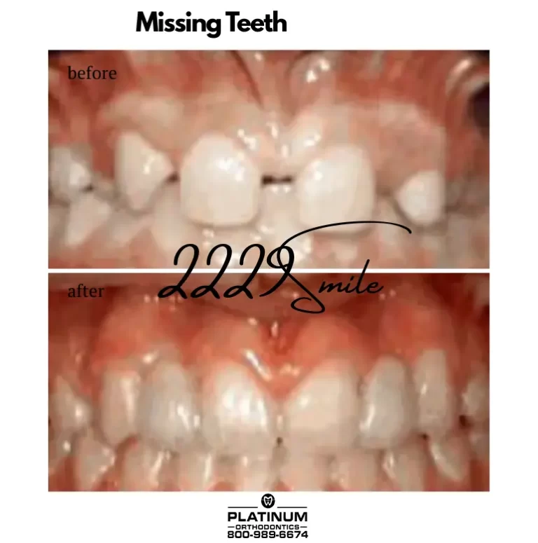 Before and after: Missing Teeth