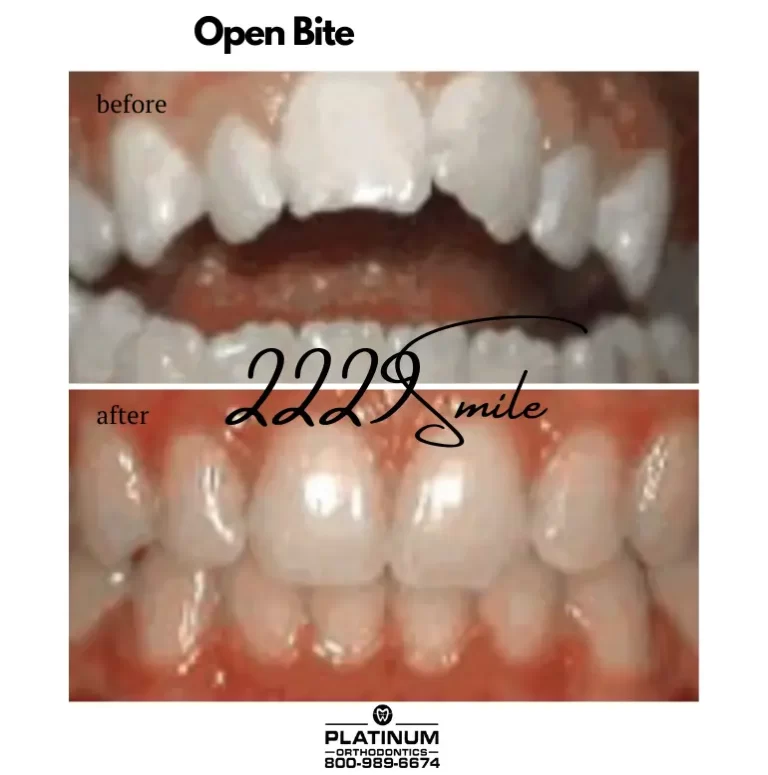 Before and after: Open Bite