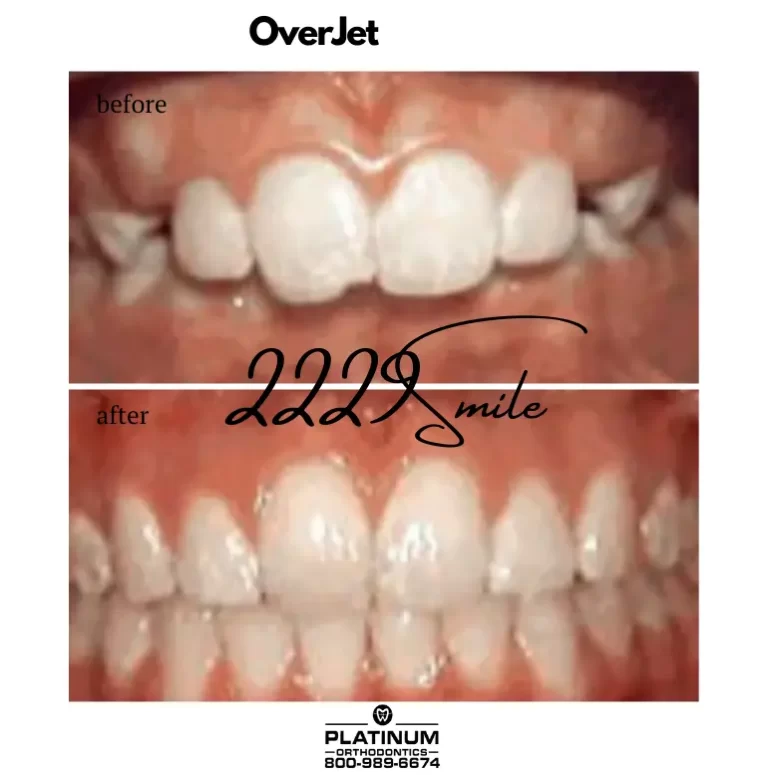 Before and after: Overjet