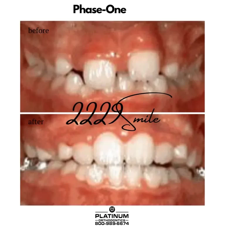 Before and after: Phase 1 (Early Treatment)