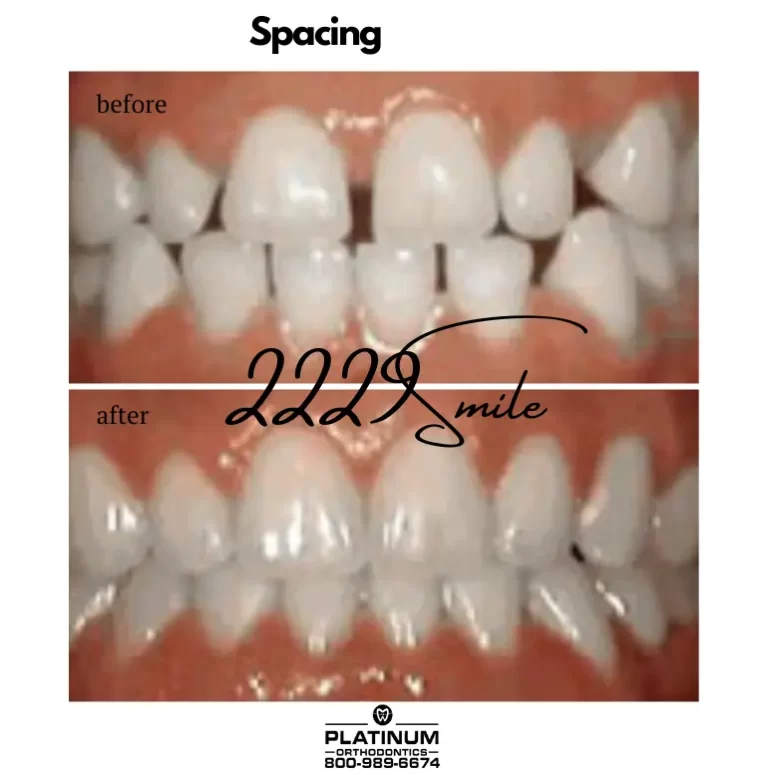 Before and after: Spacing