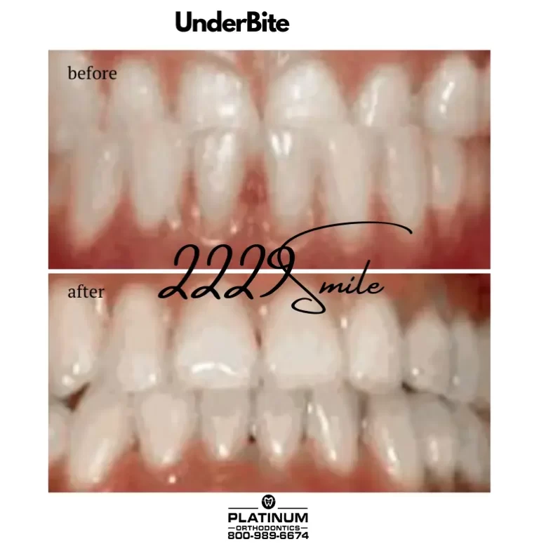 Before and after: Underbite