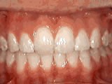 Common Orthodontic Issues