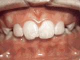 Common Orthodontic Issues