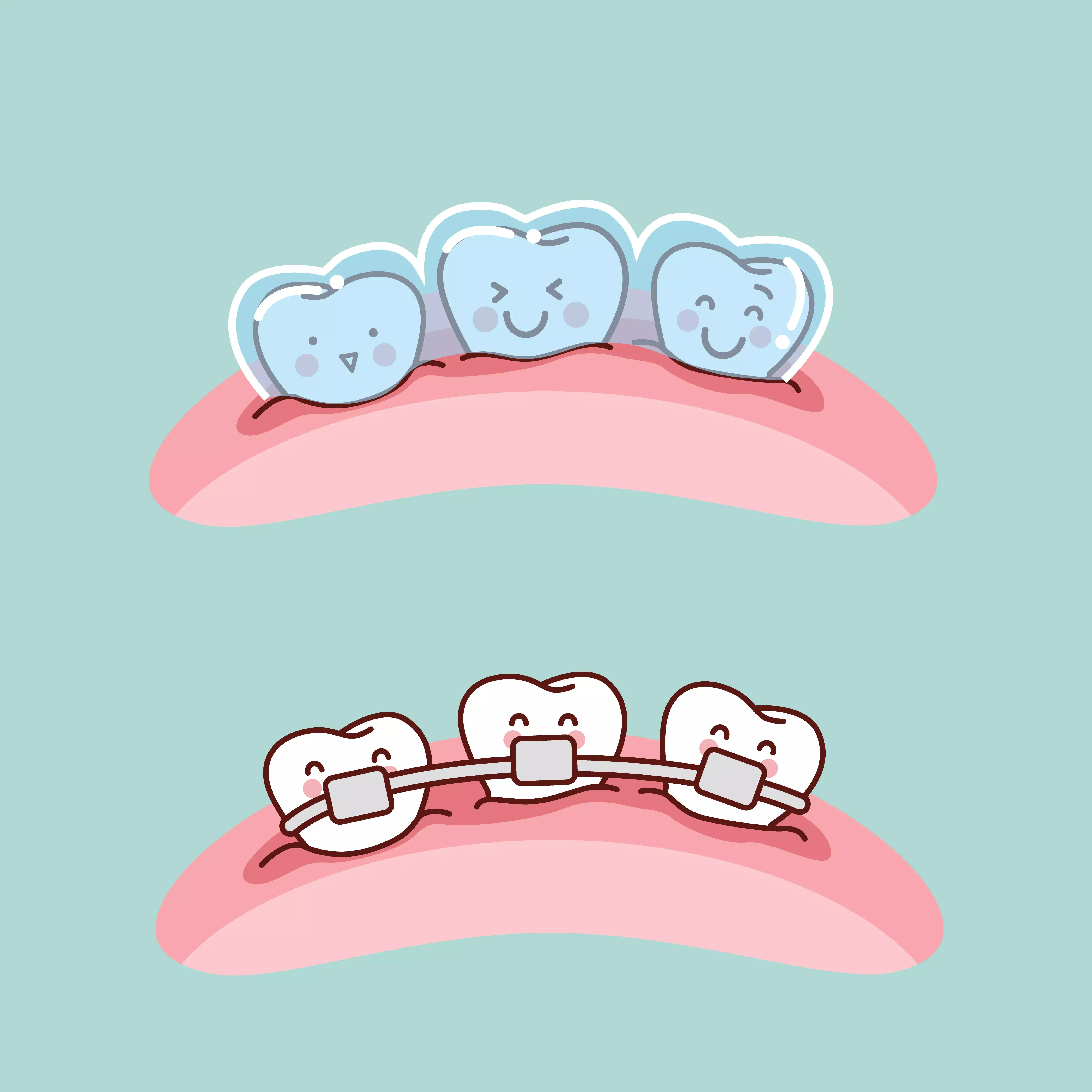 IVISALIGN VS. BRACES – WHICH IS THE RIGHT CHOICE?