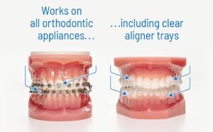 Handling Braces care at home during COVID-19