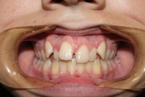 Bite problems that can be fixed with Braces