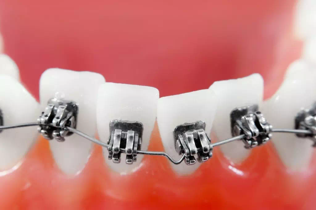 How Do Braces Fix Your Crooked or Crowded Teeth?