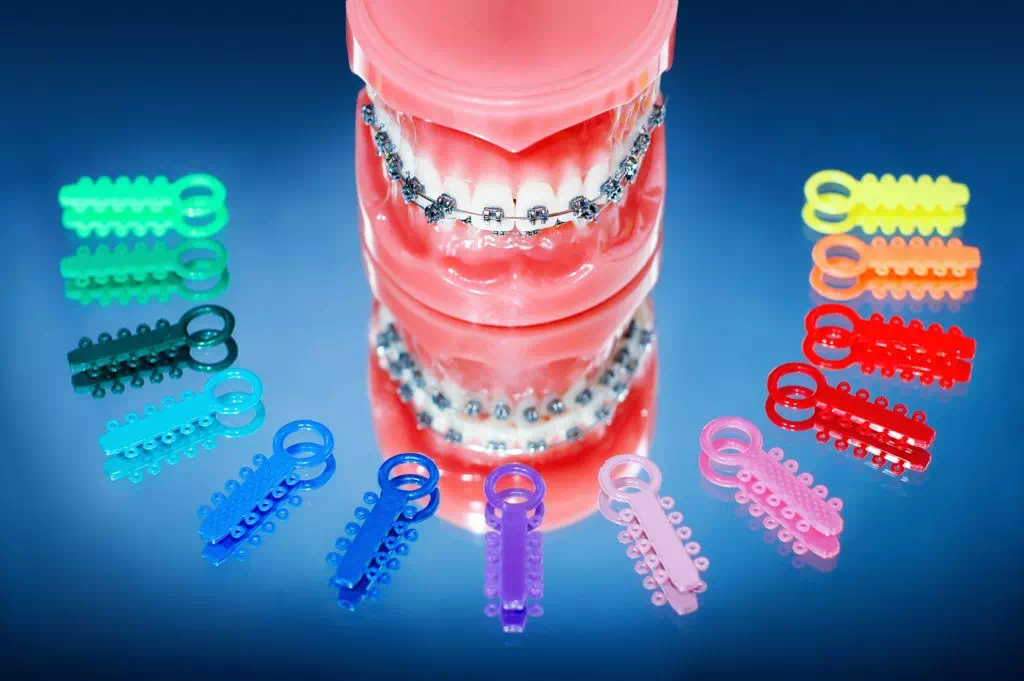 How Do Braces Fix Your Crooked or Crowded Teeth?